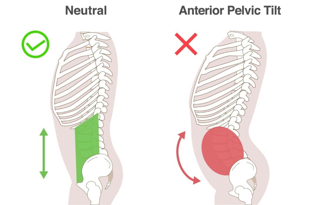 5 Anterior Pelvic Tilt Exercises and Stretches